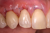 photo of gums at placement