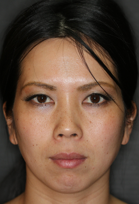 after photo of botox treatment