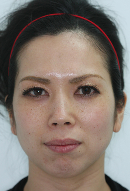 before photo of botox treatment