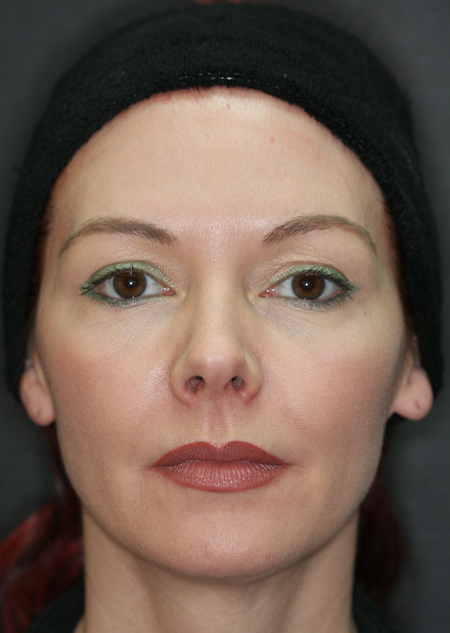 before results of botox treatment