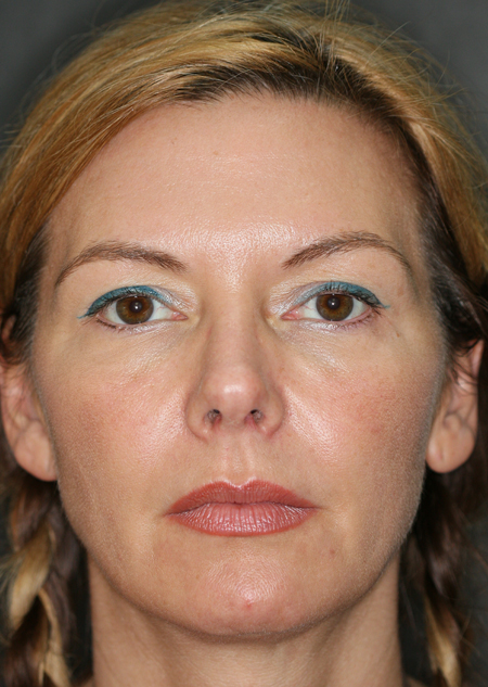 results of botox treatment