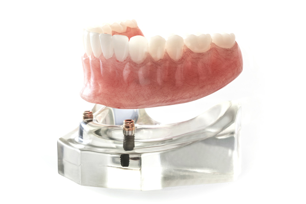 implant secured dentures