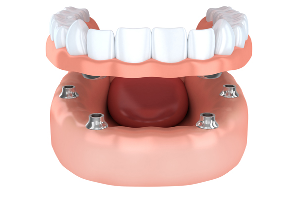 implant secured dentures