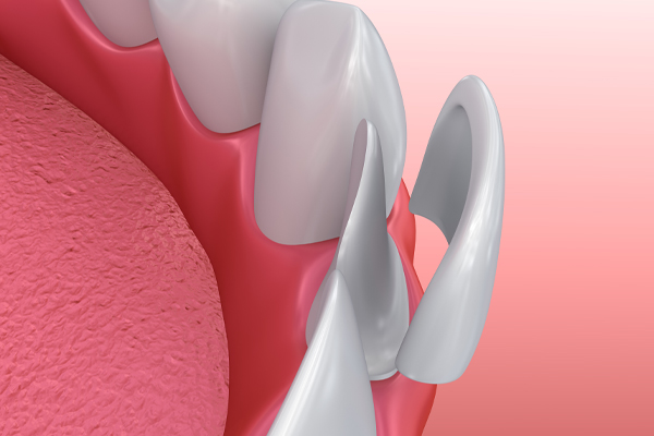 illustration of a dental veneer