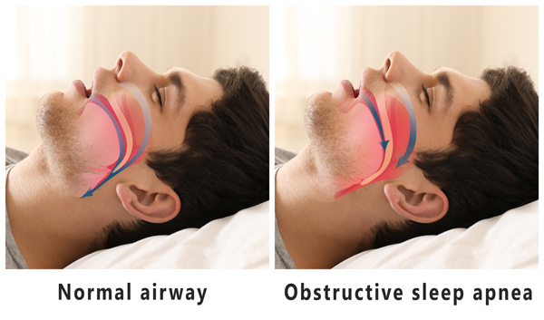 sleep apnea