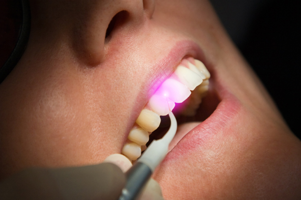 laser for dentistry