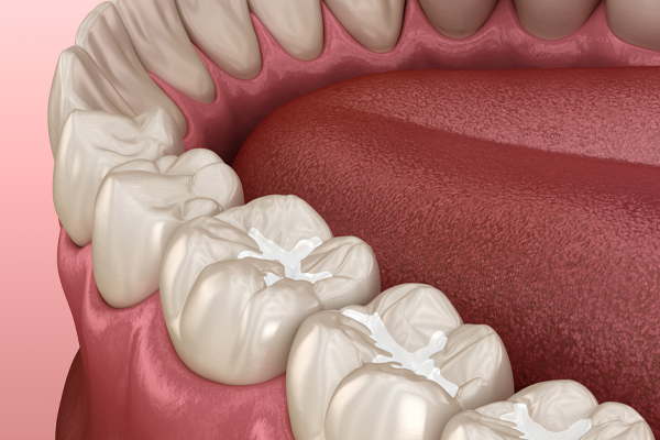 illustration of composite fillings