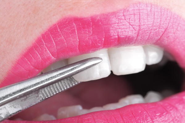 dental veneer being placed on a patient's teeth