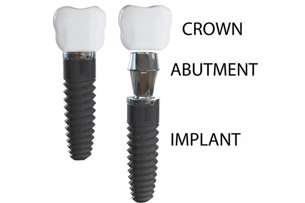 illustration of dental crown with implant