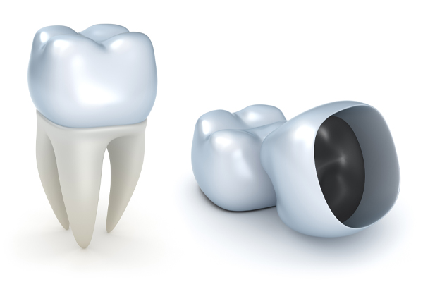 illustration of dental crown