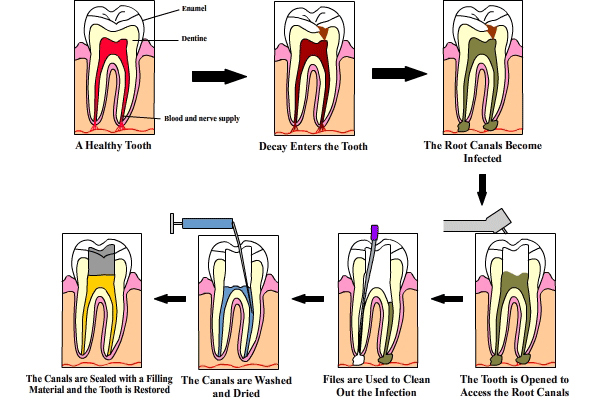 illustration of root canal treatment