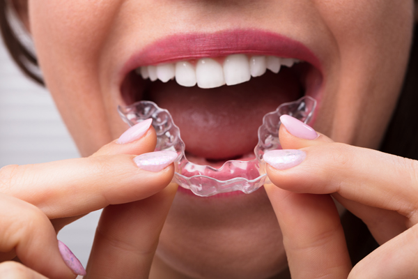 Invisalign