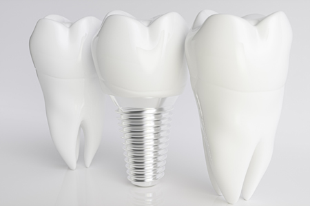 photo of dental implants