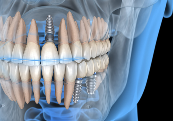 Dental Implants — Wing Dental Center | Family & Cosmetic Dentistry in Peace  River, AB