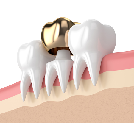 gold dental crown