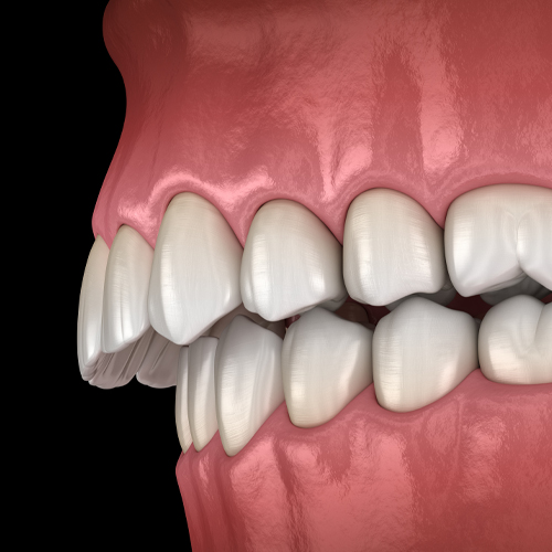 protruding upper teeth